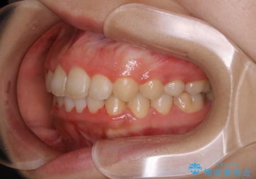 インビザラインが使えなかった:ワイヤーで仕上げ治療の治療後