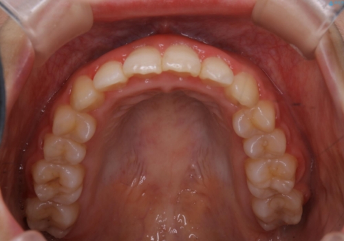 インビザラインが使えなかった:ワイヤーで仕上げ治療の治療後