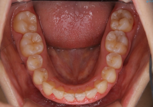 インビザラインが使えなかった:ワイヤーで仕上げ治療の治療後