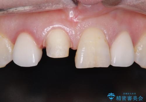 前歯のセラミッククラウン 詰め物が取れたの治療中