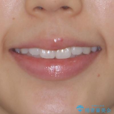 抜歯矯正の軽度後戻りを解消 インビザライン矯正の治療前(顔貌)