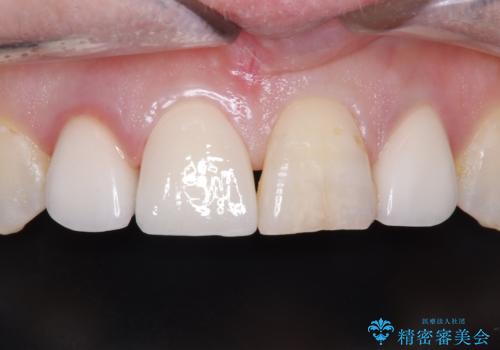 前歯のセラミッククラウン 詰め物が取れた