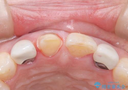 前歯のセラミッククラウン 詰め物が取れたの治療中