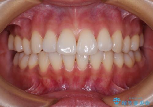 抜歯矯正の軽度後戻りを解消 インビザライン矯正の症例 治療前