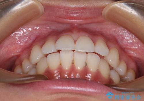 抜歯矯正の軽度後戻りを解消 インビザライン矯正の治療前