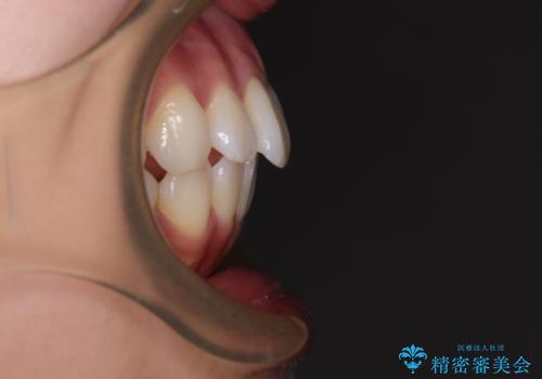 抜歯矯正の軽度後戻りを解消 インビザライン矯正の治療前