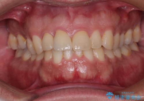 自転車で転んで前歯を損傷 前歯のオールセラミッククラウンの治療後