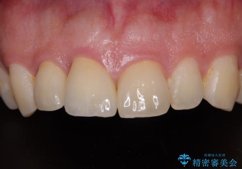 自転車で転んで前歯を損傷 前歯のオールセラミッククラウンの症例 治療後