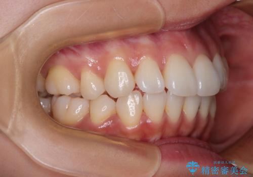 抜歯矯正の軽度後戻りを解消 インビザライン矯正の治療前