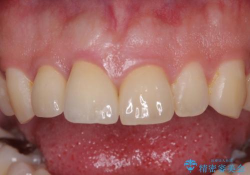 自転車で転んで前歯を損傷 前歯のオールセラミッククラウンの治療後