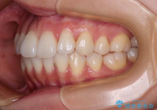抜歯矯正の軽度後戻りを解消 インビザライン矯正の治療前