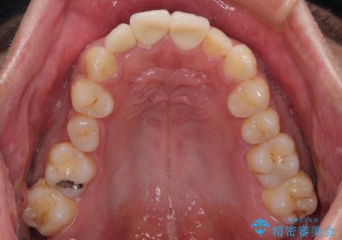 自転車で転んで前歯を損傷 前歯のオールセラミッククラウンの治療後