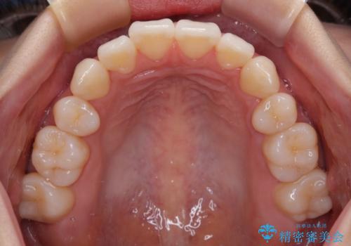 抜歯矯正の軽度後戻りを解消 インビザライン矯正の治療前