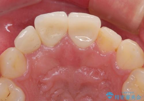 自転車で転んで前歯を損傷 前歯のオールセラミッククラウンの治療後