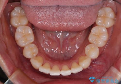 抜歯矯正の軽度後戻りを解消 インビザライン矯正の治療前