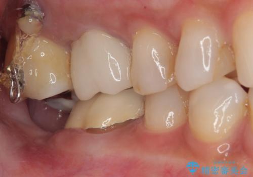 放置した奥歯 部分矯正を併用したインプラント補綴治療の治療中