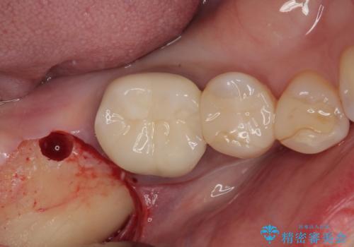放置した奥歯 部分矯正を併用したインプラント補綴治療の治療前