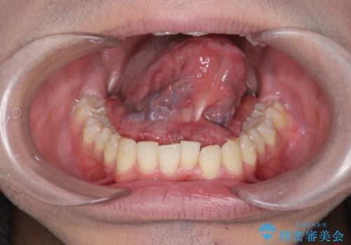 滑舌の改善 舌小帯の形成術の治療前
