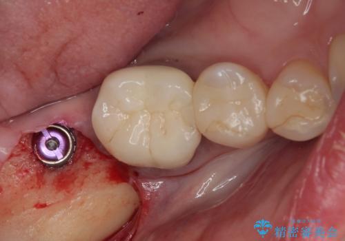 放置した奥歯 部分矯正を併用したインプラント補綴治療の治療中