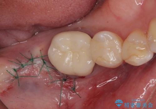 放置した奥歯 部分矯正を併用したインプラント補綴治療の治療後