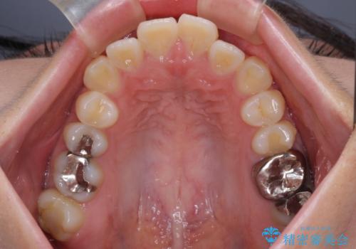 口元の突出感を改善したい。リンガルアーチを併用した抜歯矯正の治療前