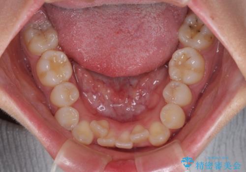 口元の突出感を改善したい。リンガルアーチを併用した抜歯矯正の治療前