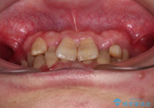 全体的なデコボコが気になる。拡大装置を併用したワイヤー矯正の治療前