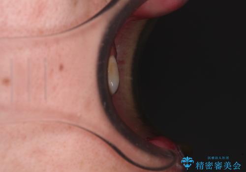 全体的なデコボコが気になる。拡大装置を併用したワイヤー矯正の治療前