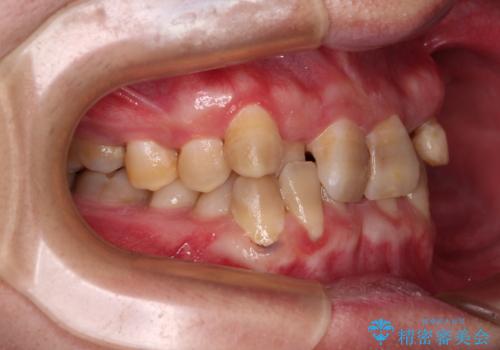 全体的なデコボコが気になる。拡大装置を併用したワイヤー矯正の治療前