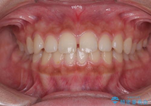 気になるすきっ歯を短期間で改善　インビザライン矯正の治療前
