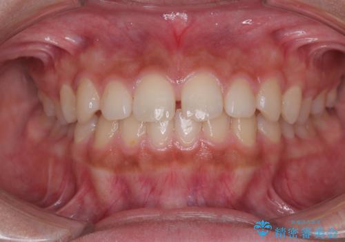 気になるすきっ歯を短期間で改善 インビザライン矯正の症例 治療前