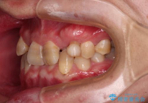 全体的なデコボコが気になる。拡大装置を併用したワイヤー矯正の治療前