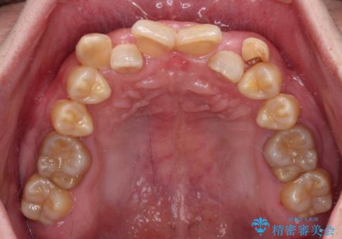 全体的なデコボコが気になる。拡大装置を併用したワイヤー矯正の治療前