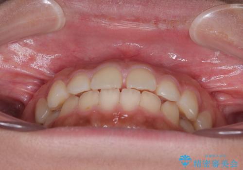 気になるすきっ歯を短期間で改善 インビザライン矯正の治療前