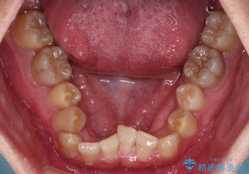全体的なデコボコが気になる。拡大装置を併用したワイヤー矯正の治療前