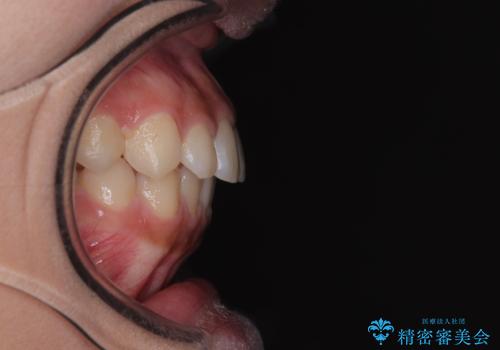 気になるすきっ歯を短期間で改善 インビザライン矯正の治療前