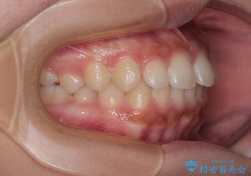 気になるすきっ歯を短期間で改善 インビザライン矯正の治療前