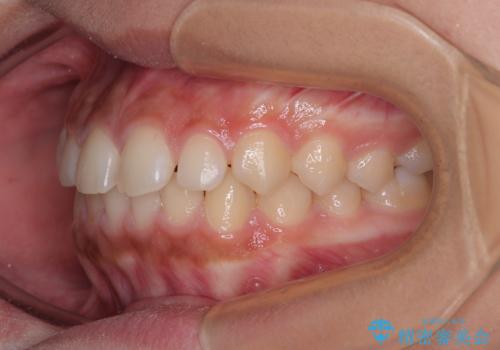 気になるすきっ歯を短期間で改善 インビザライン矯正の治療前