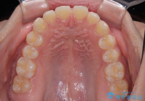 気になるすきっ歯を短期間で改善 インビザライン矯正の治療前
