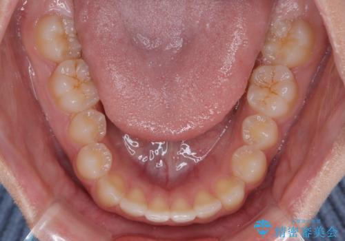 気になるすきっ歯を短期間で改善 インビザライン矯正の治療前