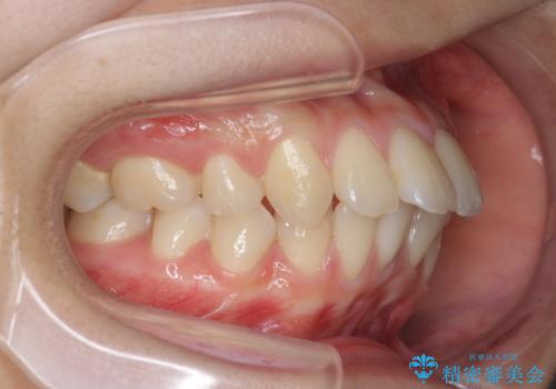 突き出た前歯の改善!マウスピースで再矯正の治療前