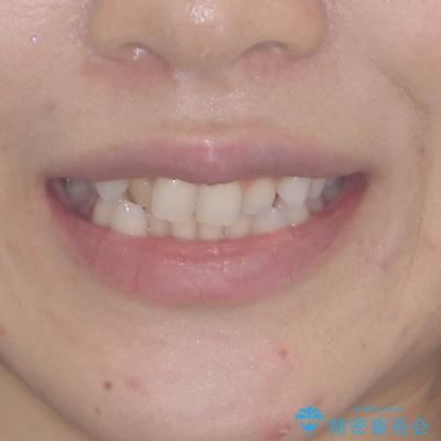 前歯のデコボコとクロスバイト ワイヤー装置での抜歯矯正の治療前(顔貌)