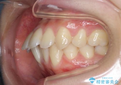 突き出た前歯の改善!マウスピースで再矯正の治療前