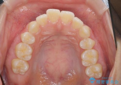 突き出た前歯の改善!マウスピースで再矯正の治療前