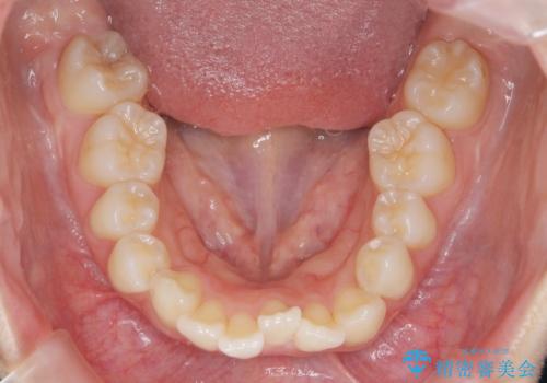 突き出た前歯の改善!マウスピースで再矯正の治療前