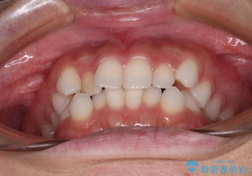 前歯のデコボコとクロスバイト ワイヤー装置での抜歯矯正の治療前