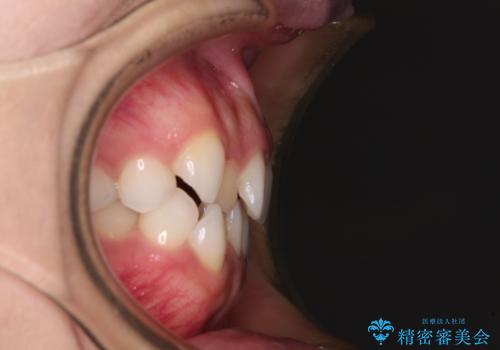 前歯のデコボコとクロスバイト ワイヤー装置での抜歯矯正の治療前