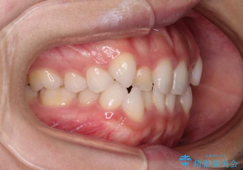 前歯のデコボコとクロスバイト ワイヤー装置での抜歯矯正の治療前