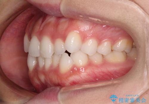 前歯のデコボコとクロスバイト ワイヤー装置での抜歯矯正の治療前