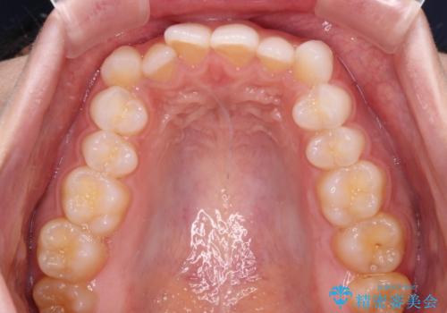 前歯のデコボコとクロスバイト ワイヤー装置での抜歯矯正の治療前